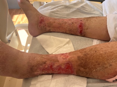 Joanne's wounds on admission