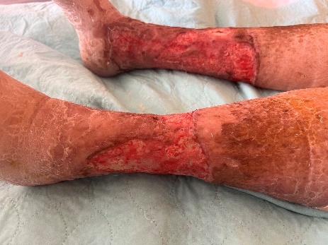 Joanne's wounds on discharge